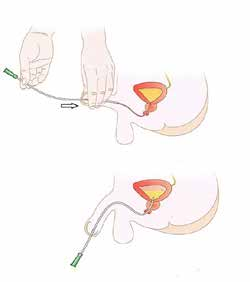 Cateterismo limpio intermitente en paciente varón